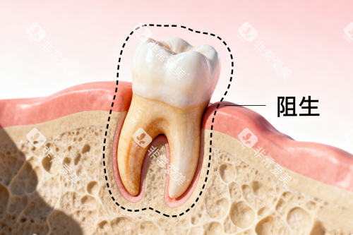 口腔智齿卡通展示图 口腔智齿卡通展示图