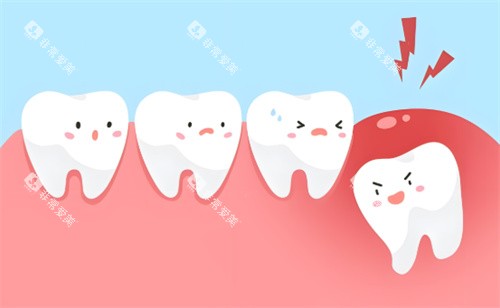 拔智齿动画 拔智齿动画