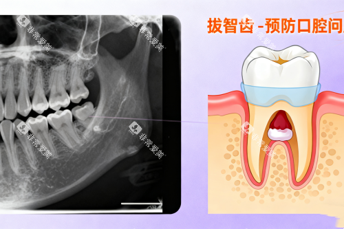 拔智齿卡通展示图 拔智齿卡通展示图