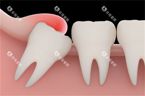 智齿萌出牙龈红肿 智齿萌出牙龈红肿