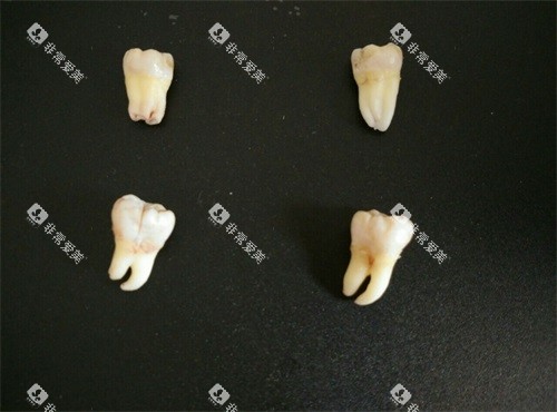 不同类型智齿实物展示图 不同类型智齿实物展示图