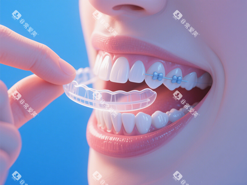 隐形牙套和附件 隐形牙套和附件