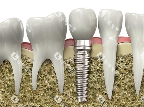 种植牙牙槽骨照片 种植牙牙槽骨照片