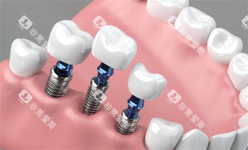 种植牙在口腔内的样子 种植牙在口腔内的样子