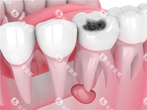 牙齿根管囊肿 牙齿根管囊肿