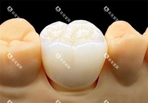 泽康全瓷冠 泽康全瓷冠