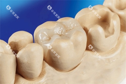 补牙嵌体修复结果 补牙嵌体修复结果