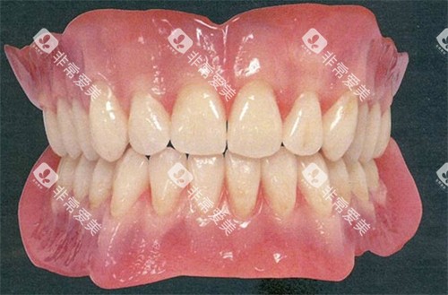 还原真牙的全瓷牙 还原真牙的全瓷牙