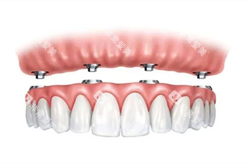 全口种植牙图示