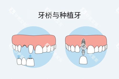 牙冠桥和种植牙对比图 牙冠桥和种植牙对比图