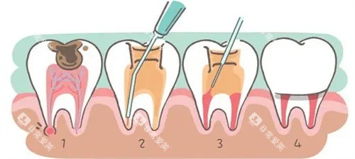 牙周治疗过程图