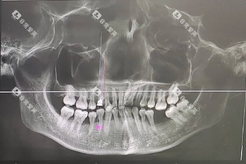 牙周炎 牙龈萎缩 缺牙