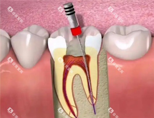 根管治疗动画模拟图