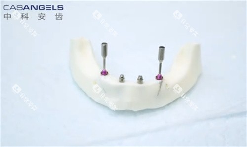 中科安齿种植牙