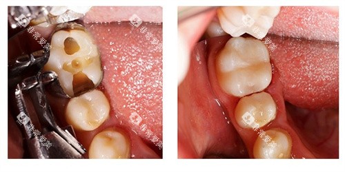 树脂补牙前后