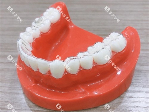 牙齿矫正隐形牙套模型图 牙齿矫正隐形牙套模型图