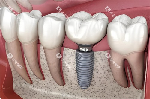 种植牙动画示图 种植牙动画示图
