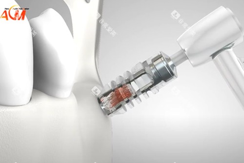 德国ACM种植牙示意图 德国ACM种植牙示意图