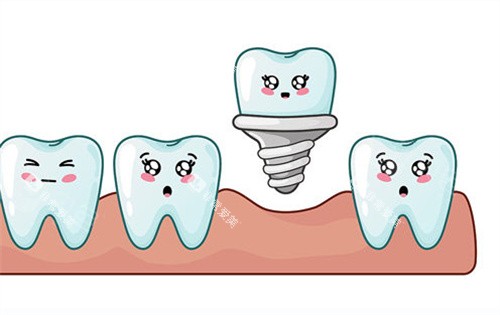种植牙动画展示图片 种植牙动画展示图片