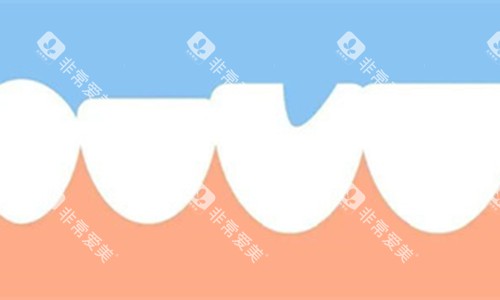 牙齿缺失一块展示图