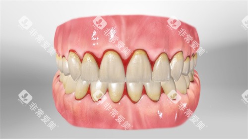 牙齿根部牙龈出血