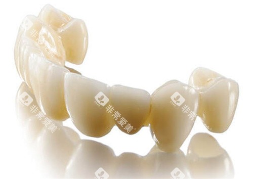 lava全瓷牙连桥冠