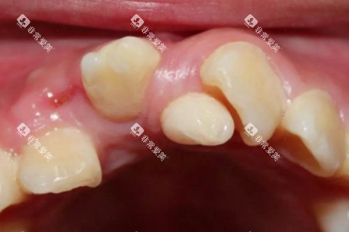 牙齿畸形问题模型图 牙齿畸形问题模型图