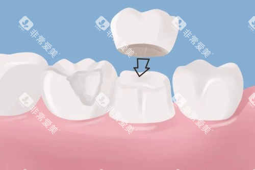镶牙卡通图片展示 镶牙卡通图片展示