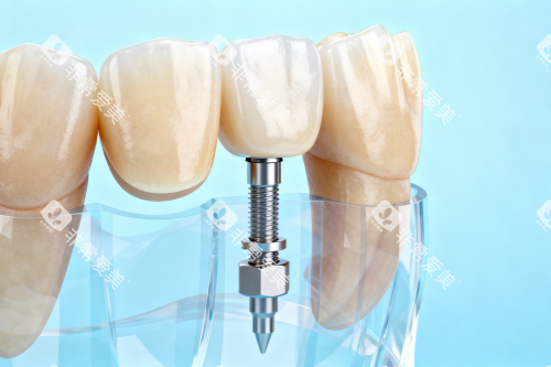 种植牙与正常牙齿前后对比图 种植牙与正常牙齿前后对比图