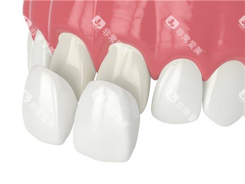 牙齿贴面安装 牙齿贴面安装