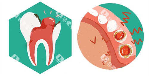 牙齿内息肉动画 牙齿内息肉动画