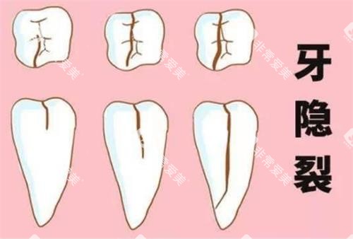 牙齿裂纹的程度