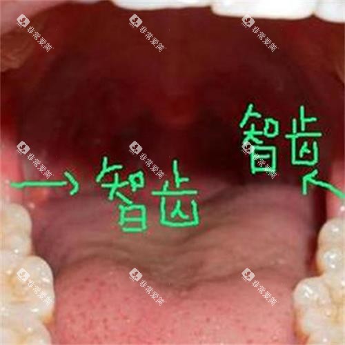 牙齿智齿所在位置