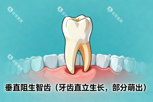 垂直阻生智齿展示图