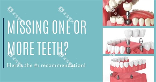 不同种植牙方式图示