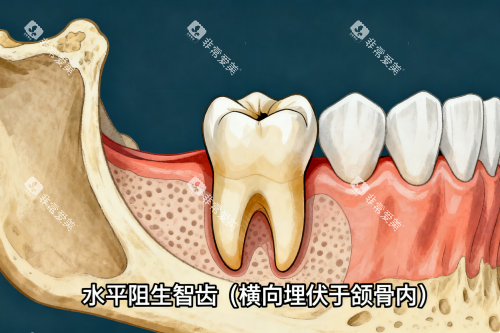 水平阻生智齿一览