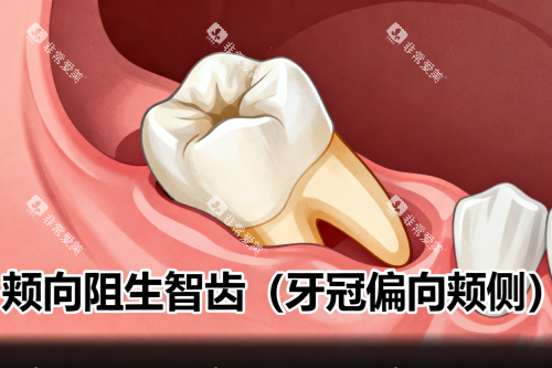 颊向阻生智齿展示图一览
