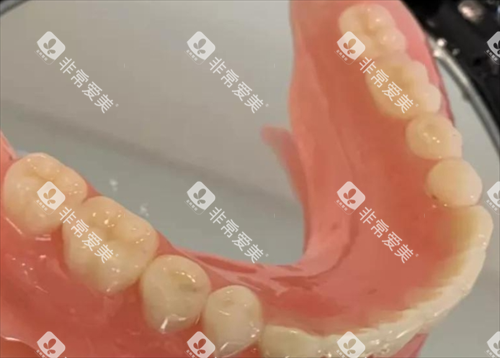 半口固定假牙模型展示