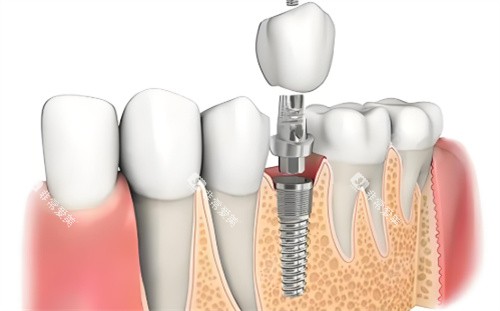 种植牙材料展示 种植牙材料展示