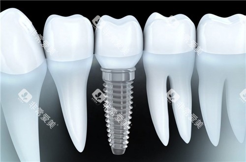 单颗种植牙图示