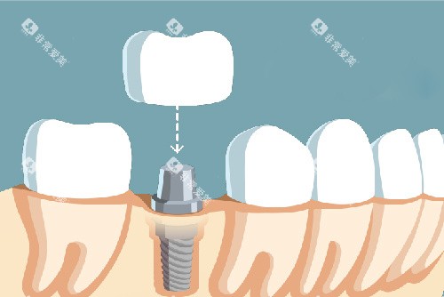 单颗种植牙牙冠安装漫画图 单颗种植牙牙冠安装漫画图