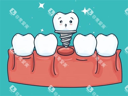 种植牙漫画 种植牙漫画