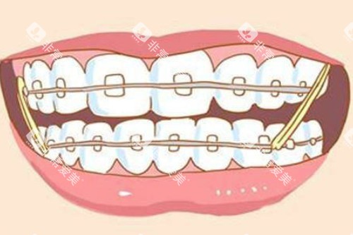 牙齿矫正卡通图片展示 牙齿矫正卡通图片展示