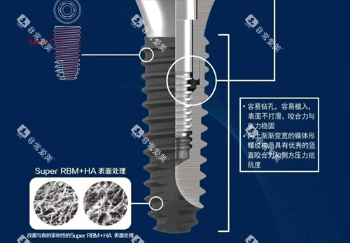 种植牙处理 种植牙处理