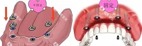 半口半固定种植牙 半口半固定种植牙