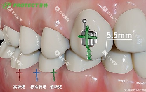 普特牙套托槽示意图