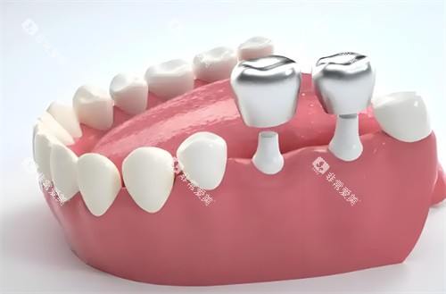 种植牙示意图片