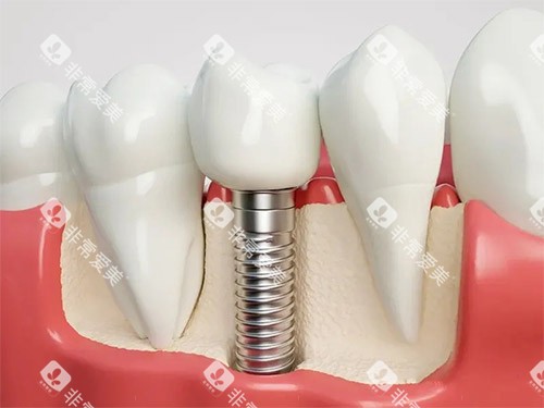 种植牙模型解刨图