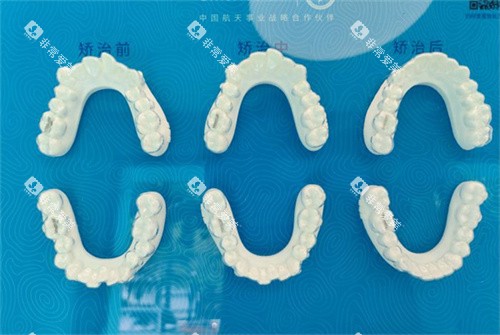 北京美笑口腔牙齿矫正成效对比图