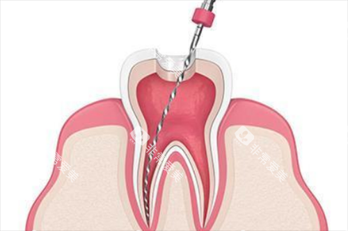 根管治疗卡通示意图